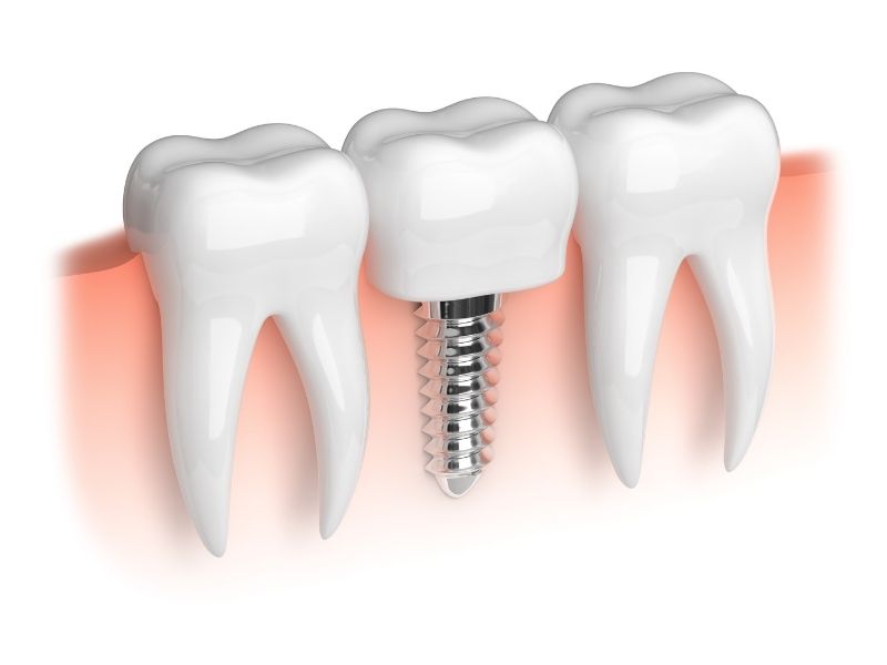 oral implants