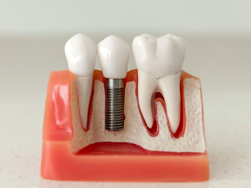  oral implants