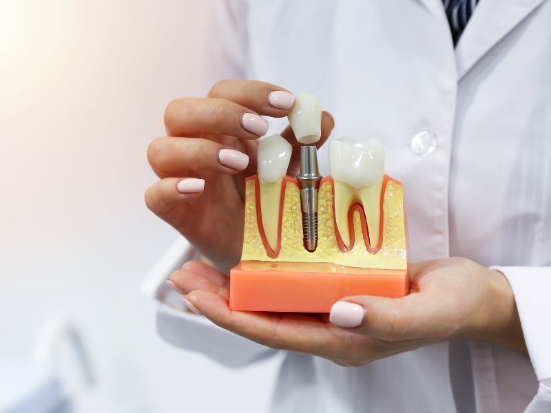 Things You Need To Know About Having Dental Implants