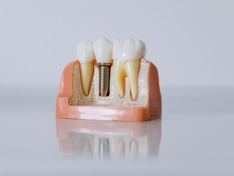 New Replacement Teeth With Dental Implants