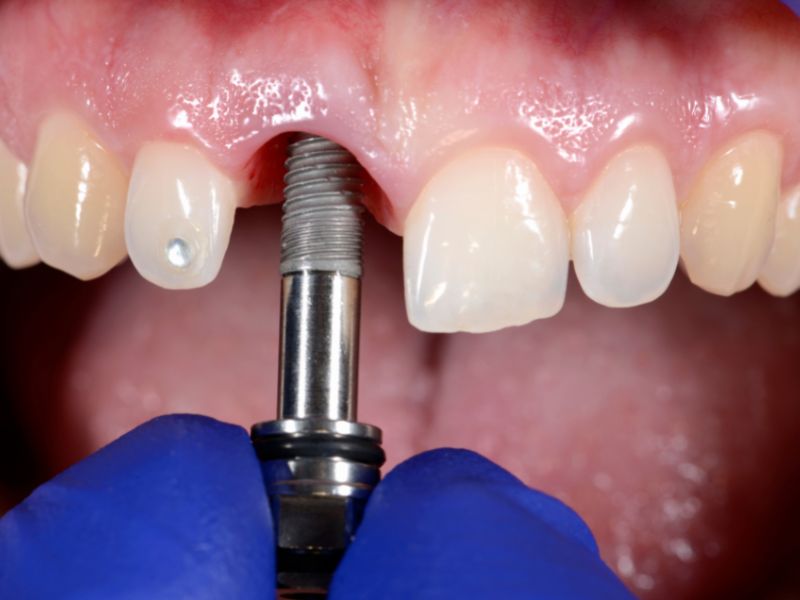 How To Replace your Tooth With A Dental Implant